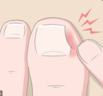 Alicate de Podologia para Unhas Encravadas e Grossas