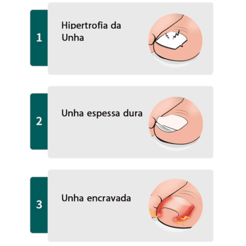 Alicate de Podologia para Unhas Encravadas e Grossas + Kit Manicure